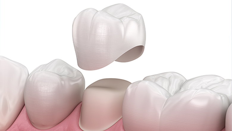 Are-Dental-Crowns-Right-for-You-What-to-Consider-Before-Getting-Them