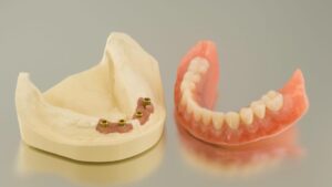 Dental implant vs dentures