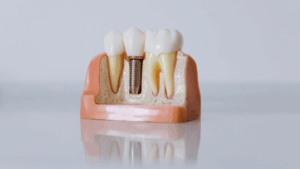 Everything You Need to Know About Dental Bridges: From Bridge Crowns to Fixed Solutions