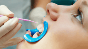 Dental Sealants for Sensitive Teeth: Relief or Risk?