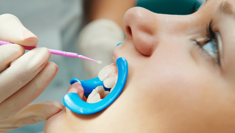 Dental Sealants for Sensitive Teeth: Relief or Risk?
