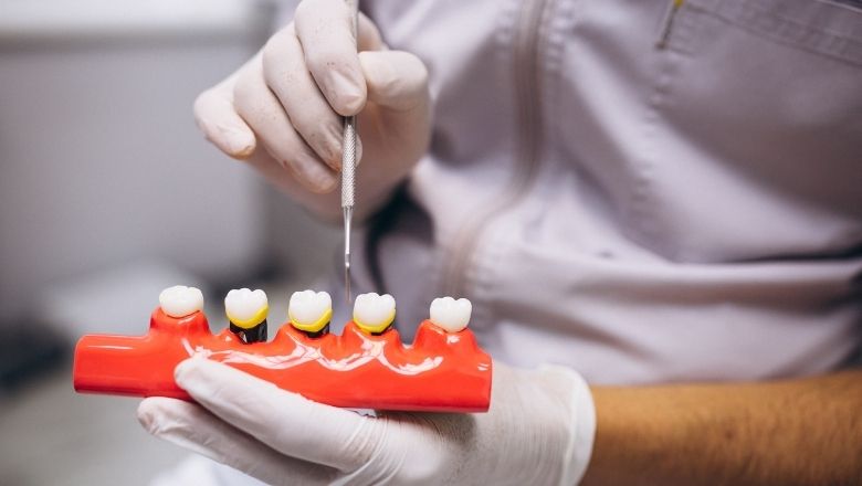 No Temporary Crowns Needed with Same Day Treatment