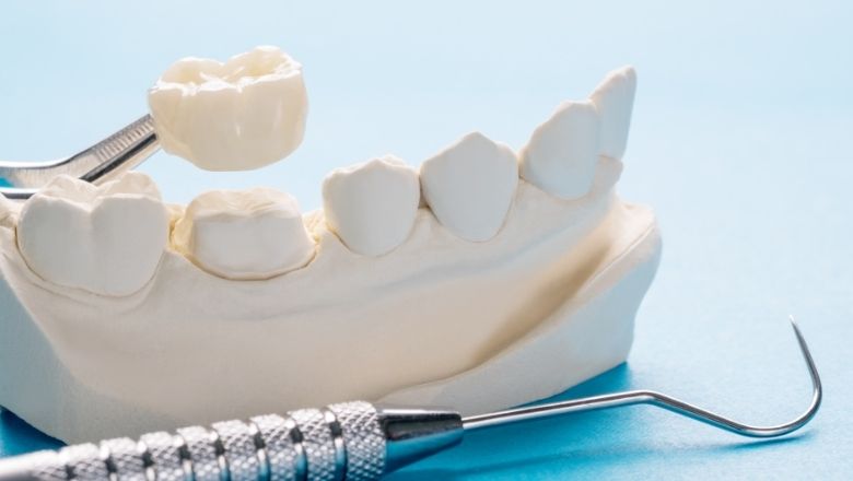 Do Dental Crowns Hurt? Understanding Comfort Levels from a Tacoma Dentist’s Perspective