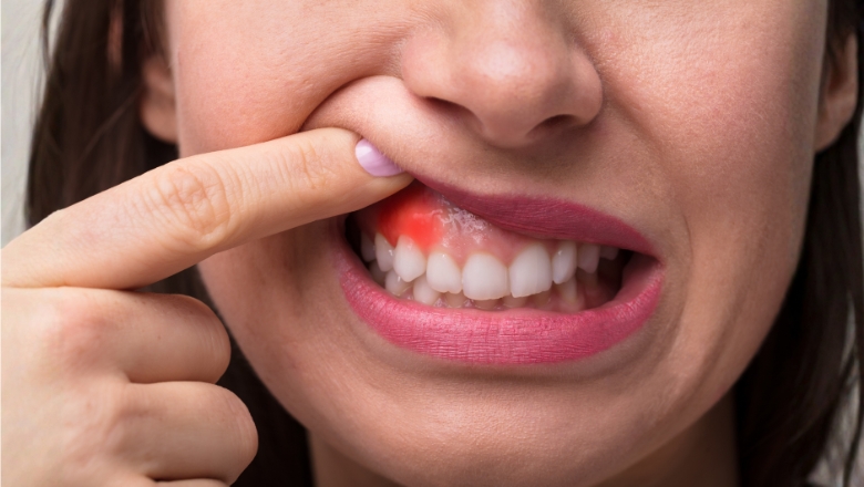 Swelling Around One Tooth: What It Means and How to Treat It
