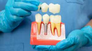 Signs Your Dental Crown Needs Replacement