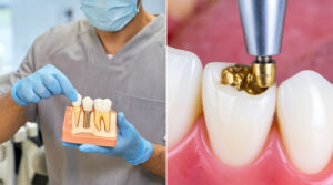 Dental Crown vs Filling: Which One Do You Really Need?