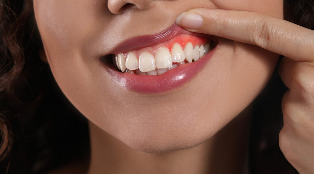 Early Signs of Gum Disease You Should Never Ignore