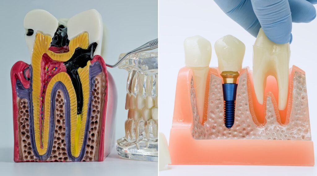 Root Canal vs. Extraction: Which Option Actually Saves Your Tooth?