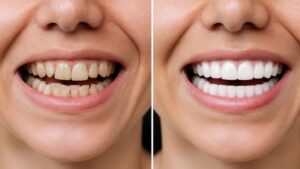 How Long Do Dental Veneers Last and Are They Worth It?