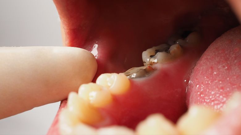 How to Reverse Early Tooth Decay Without Fillings