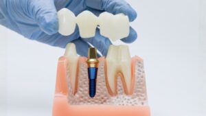 What Patients Can Expect When Getting a Dental Crown