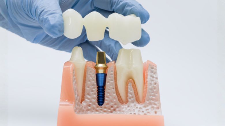 What Patients Can Expect When Getting a Dental Crown