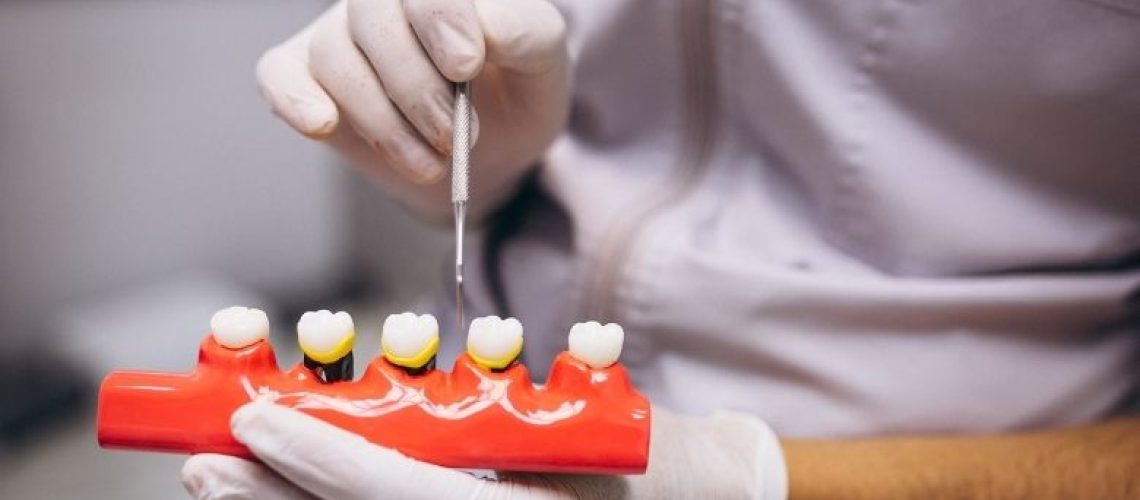 No Temporary Crowns Needed with Same Day Treatment