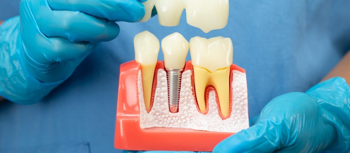Signs Your Dental Crown Needs Replacement