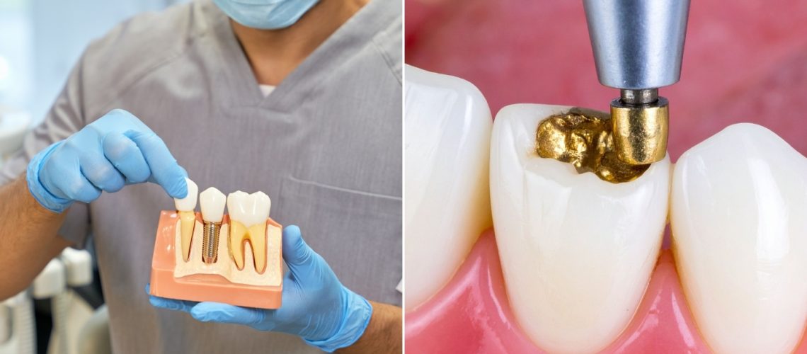 Dental Crown vs Filling: Which One Do You Really Need?