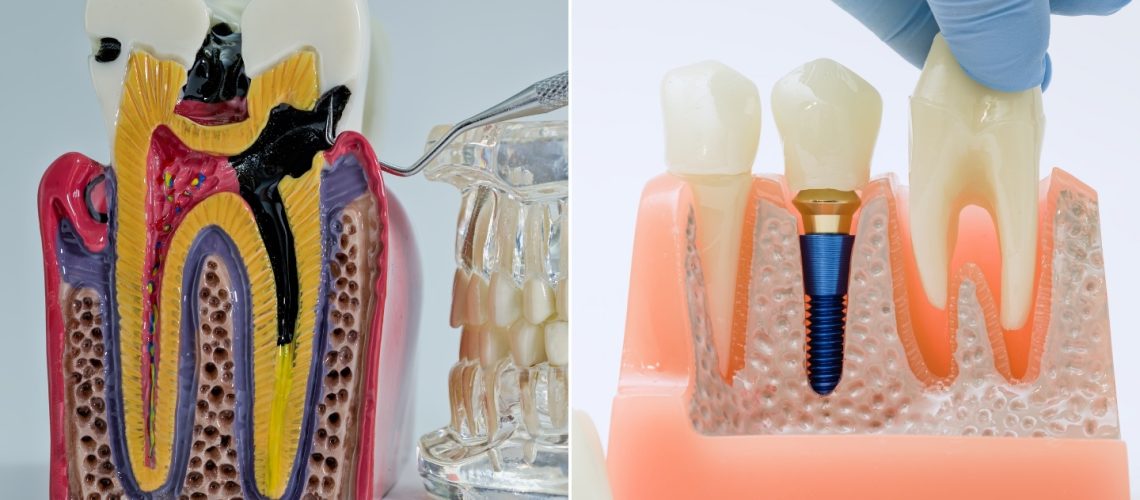 Root Canal vs. Extraction: Which Option Actually Saves Your Tooth?