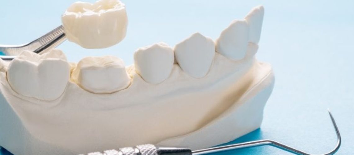 Do Dental Crowns Hurt? Understanding Comfort Levels from a Tacoma Dentist’s Perspective