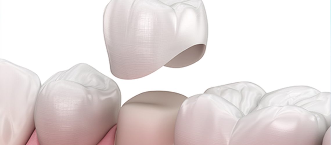 Are-Dental-Crowns-Right-for-You-What-to-Consider-Before-Getting-Them