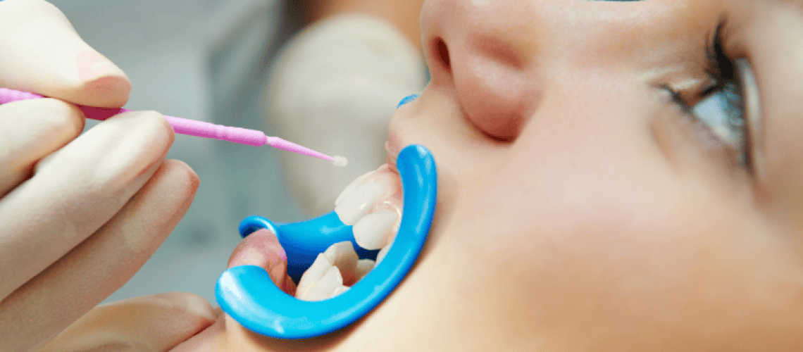 Dental Sealants for Sensitive Teeth: Relief or Risk?