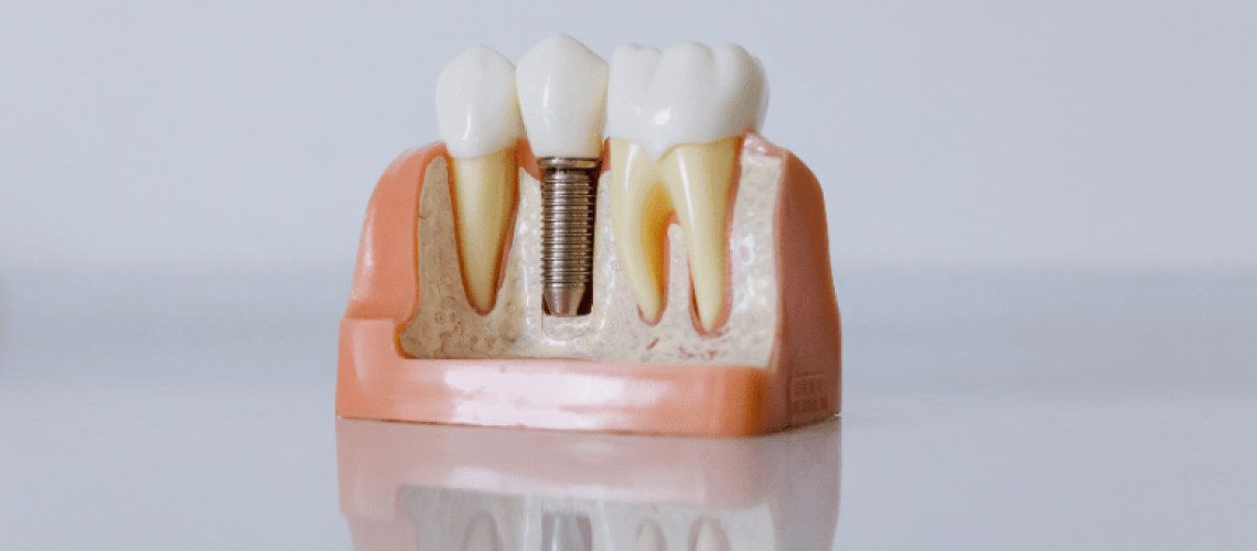 Everything You Need to Know About Dental Bridges: From Bridge Crowns to Fixed Solutions