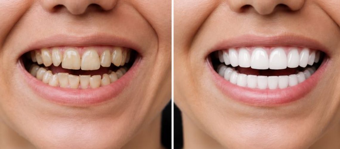 How Long Do Dental Veneers Last and Are They Worth It?