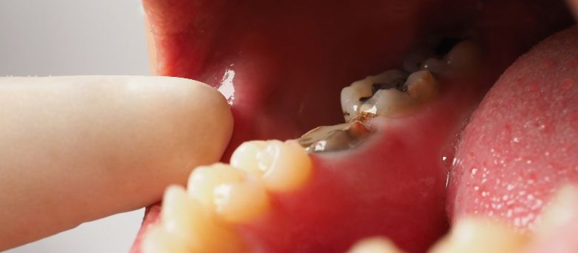 How to Reverse Early Tooth Decay Without Fillings