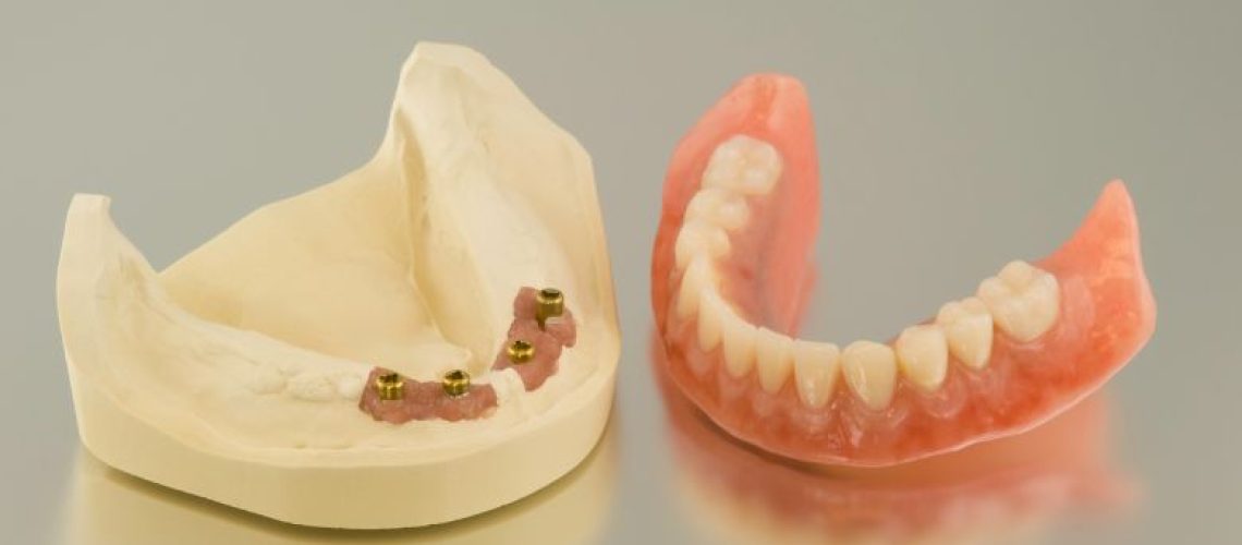 Dental implant vs dentures