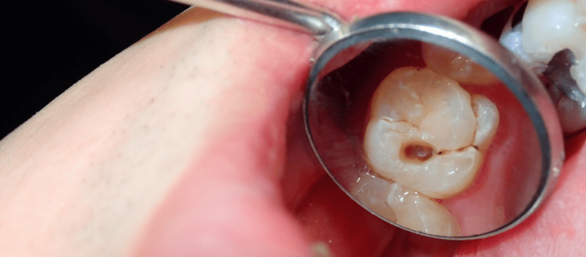 What Does a Cavity Look Like? How to Know If You Have One and What to Do Next