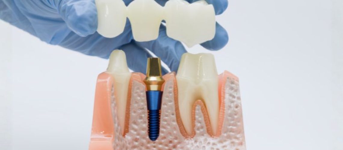 What Patients Can Expect When Getting a Dental Crown